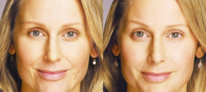 Before & After Juvederm treatment at Dignity Medical Aesthetics