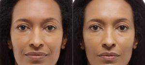 Radiesse before and after photo at Dignity Medical Aesthetics