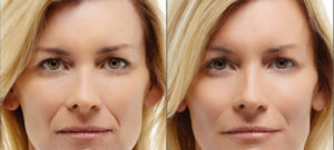 Radiesse before and after photo at Dignity Medical Aesthetics