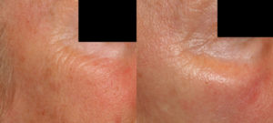 Skin Resurfacing before and after photo at Dignity Medical Aesthetics