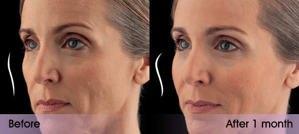 Before and after photo of a Voluma treatment at Dignity Medical Aesthetics