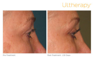 Before and after photo of a Ultherapy treatment at Dignity Medical Aesthetics
