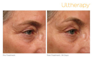 Ultherapy before and after photo at Dignity Medical Aesthetics