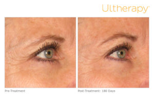 Before & After photo of Ultherapy treatment at Dignity Medical