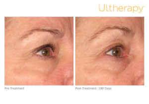 Ultherapy before & after photo at Dignity Medical