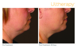 Before & After photo of Ultherapy treatment at Dignity Medical