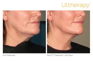 Ultherapy before and after photo at Dignity Medical Aesthetics