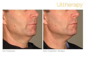 Ultherapy before & after photo at Dignity Medical