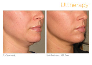 Ultherapy before and after photo at Dignity Medical