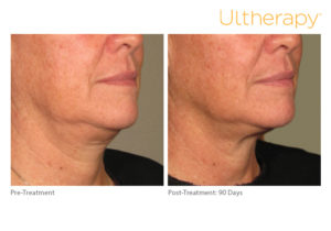 Ultherapy before & after photo at Dignity Medical Aesthetics