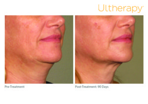 Before & After Ultherapy treatment at Dignity Medical Aesthetics
