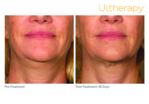 Before and after photo of a Ultherapy treatment at Dignity Medical Aesthetics