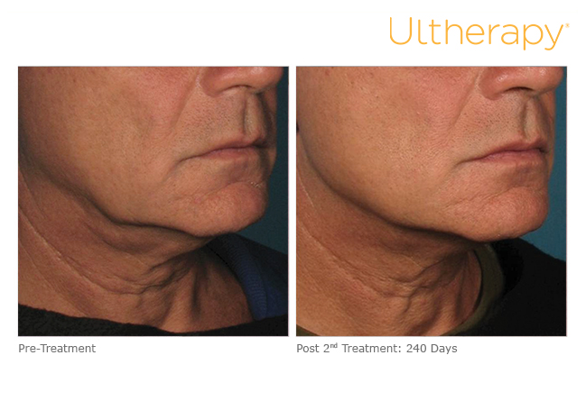 Ultherapy before & after photo at Dignity Medical Aesthetics