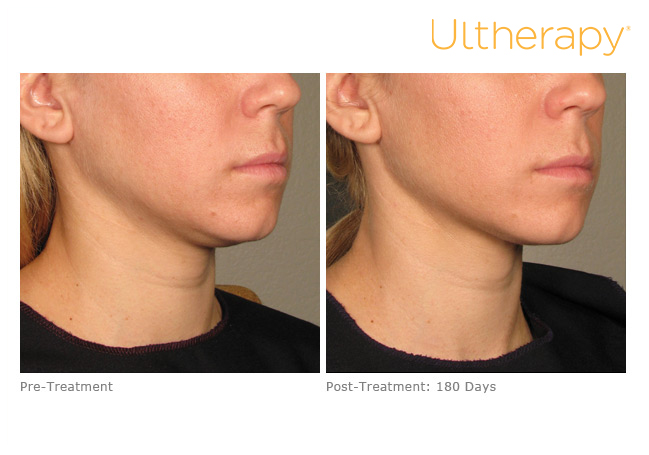 Ultherapy before and after photo at Dignity Medical