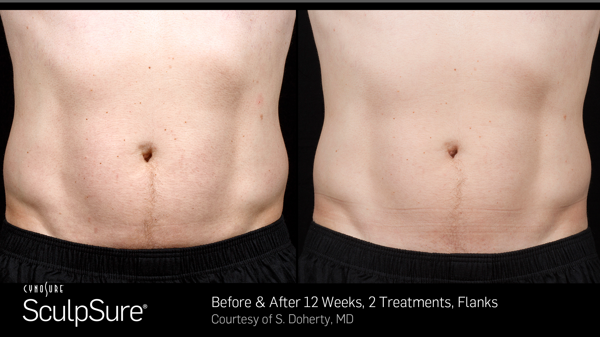 Before and After Sculpsure