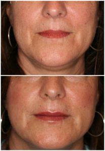 before and after juvederm filler