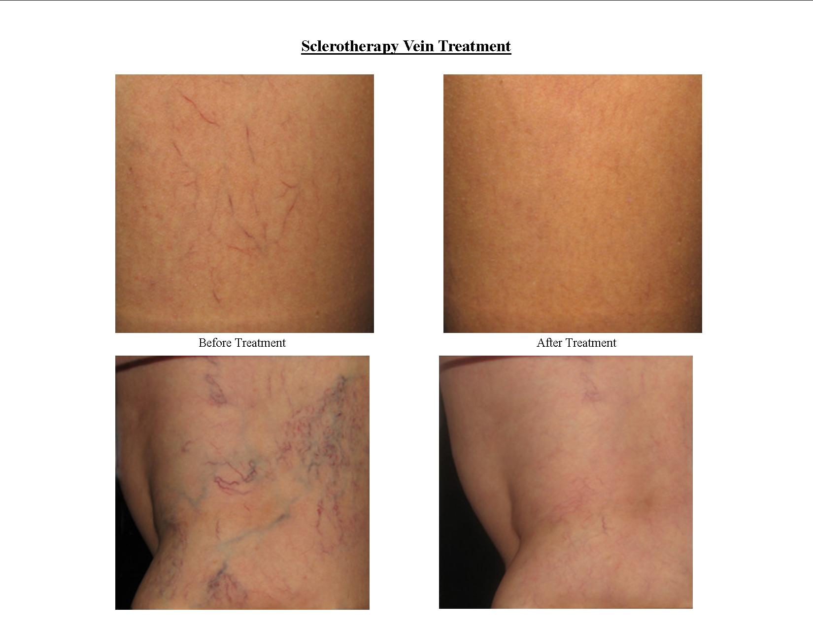 sclerotherapy vein treatment