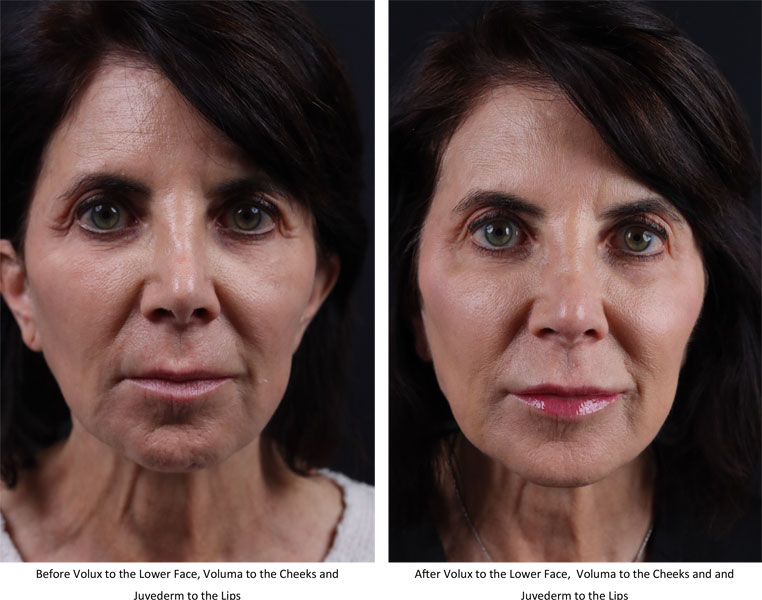 juvederm volux before and after results